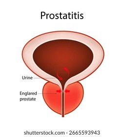 Prostatitis Anatomy of Enlarged Prostate and Urinary Issues