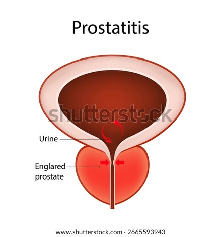Prostatitis Anatomy of Enlarged Prostate and Urinary Issues