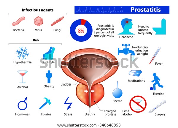 Prostatite Hyperplasie Prostatique Bénigne Infographie De Image Vectorielle De Stock Libre 