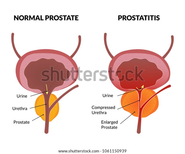 prostatitis bacteriana carcinoma crónico