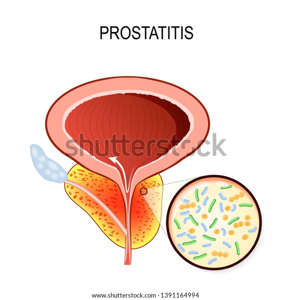 qué comer y beber cuando tienes prostatitis