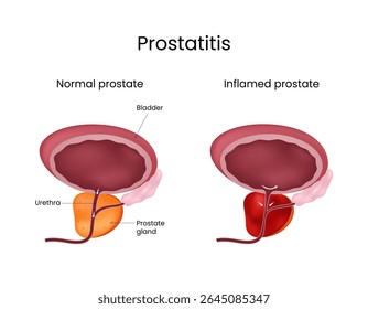 Comparação de prostatite entre glândula prostática normal e inflamada