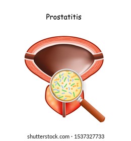 prostatitis. Male bladder and prostate. magnifying glass showing bacteria that causing this disease. Close up of microbes 