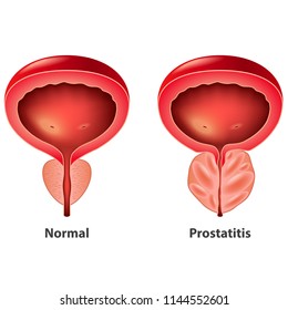 Prostatitis a férfiak órájában)