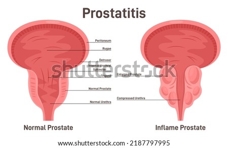 Prostatitis. Pathological disruption of male gland with enlarged into malignant genital. Impaired reproductive function and urethra blockage. Flat vector illustration