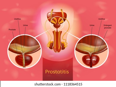 Prostatitis és ciszták vele