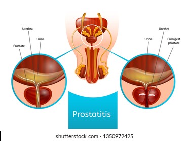 Artrita prostatita