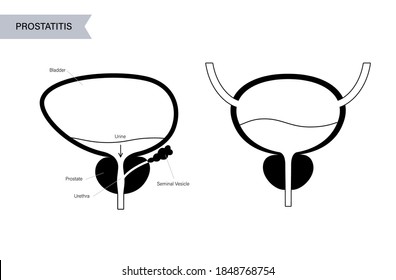 Prostatitis Swelling Inflammation Prostate Gland Normal Stock Vector ...