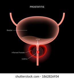 Prostatitis Swelling And Inflammation Of Prostate Gland 3d Xray Realistic Vector Illustration. Painful And Difficult Urination Diagnosis. Disease And Pain In Human Male Body. Bladder Anatomy Concept