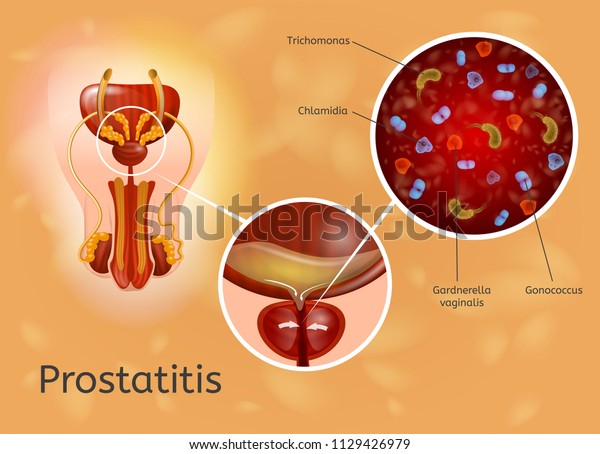 prostatitis causada por clamidia prostatitis causada por clamidia