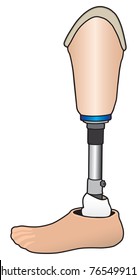 Prosthesis built for left leg below knee amputee