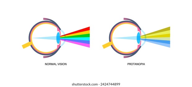 In: Protanopia vision, color blindness infographic. Konzept der menschlichen Sehschwäche. Unterschied zwischen Farben, Helligkeit und Intensität der Schattierungen. Abbildung eines flachen Vektors mit Augenanomalie