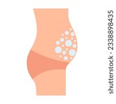 Protruding belly of human with bloating, flatulence, bubbles in tummy. Irritable bowel syndrome, IBS. Symptom in intestine and stomach. Vector illustration