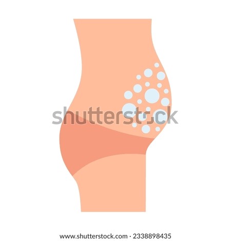 Protruding belly of human with bloating, flatulence, bubbles in tummy. Irritable bowel syndrome, IBS. Symptom in intestine and stomach. Vector illustration