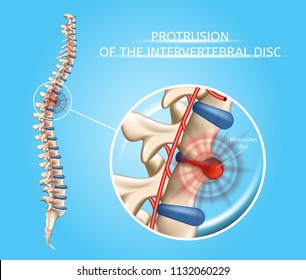Protrusion of Intervertebral Disc Realistic Vector Medical Poster with Magnification of Damaged, Painful Spine Disc. Human Musculoskeletal System Problems with Disease Symptoms Explaining Illustration