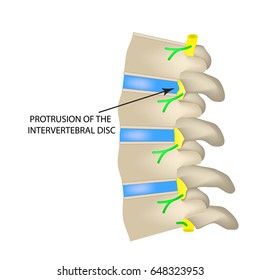 Hernia Intervertebral Disc Illustration On Isolated Stock Illustration ...