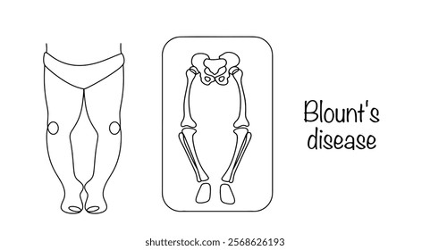 Proximal tibia deformity and internal tibia deformity. Painted legs and x-ray for Blount's disease. Medical vector illustration.