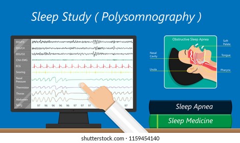 PSG sleep study test apnea diagnose Periodic limb movement disorder positive airway pressure CPAP restless leg syndrome Epworth Sleepiness Scale