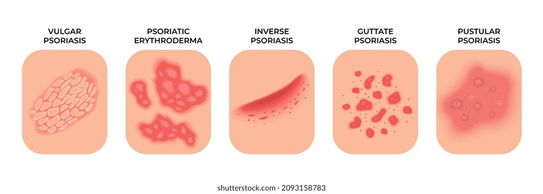 Psoriasis. Ecemas alérgicos, tratamiento de las erupciones. manchas infecciosas dermatológicas, enfermedades de la piel. Problemas de infección por epidermis reciente concepto de vector