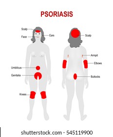 Psoriasis. Áreas del cuerpo más afectadas. Silueta femenina con ubicación destacada de la enfermedad.