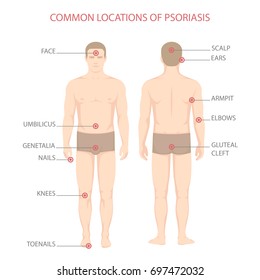 
diagrama de enfermedades psoriásicas, enfermedad de la piel del cuerpo humano, 