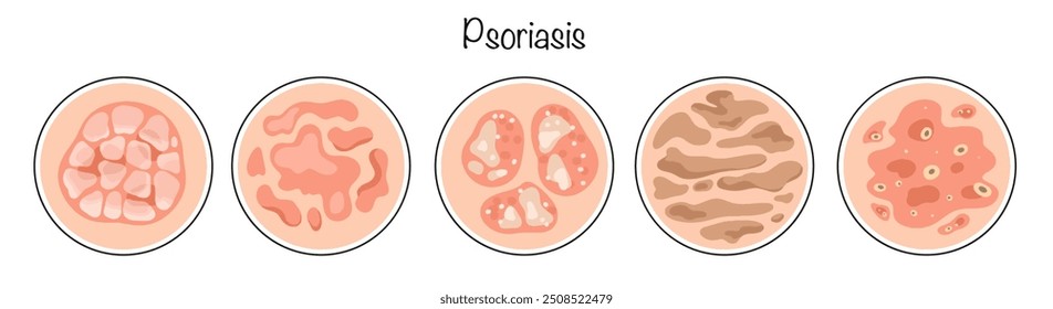 Psoríase. Doença dermatológica não infecciosa de natureza inflamatória. Os principais tipos de psoríase desenhados à mão. Doença da pele. Vetor isolado colorido.