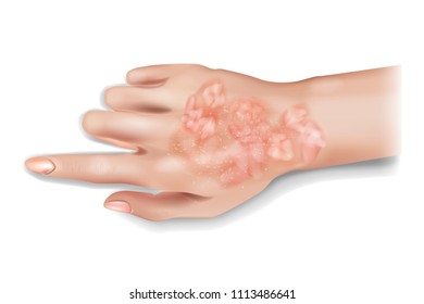 Psoriasis on human hand. Vector illustration