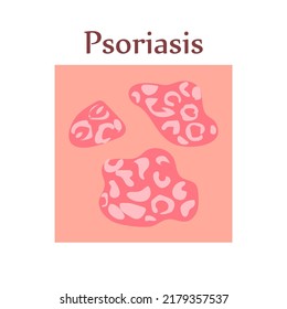 Psoriasis on human skin. Dermatological disease. The symptom is itching, pain, peeling, redness and rash. Allergic reaction. Medical diagnostics and treatment. Vector illustration