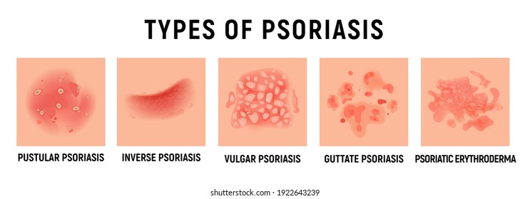 Psoriasis rash vector skin hand infection background. Psoriasis dermatitis eczema cartoon illustration