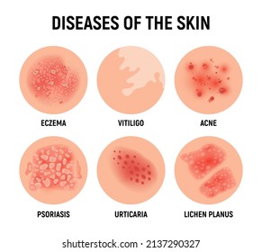 Psoriasis Rash Vector Skin Hand Infection Background. Psoriasis Dermatitis Eczema Cartoon Illustration