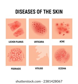 Psoriasis rash vector skin hand infection background. Psoriasis dermatitis eczema cartoon illustration