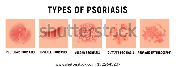 Psoriasis Rash Vector Skin Hand Infection Stock Vector (Royalty Free ...