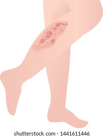 psoriasis skin disease on a white background vector illustration