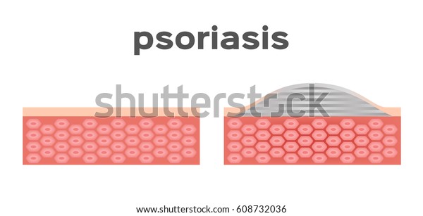 Psoriasis Skin Vector Stock Vector (Royalty Free) 608732036