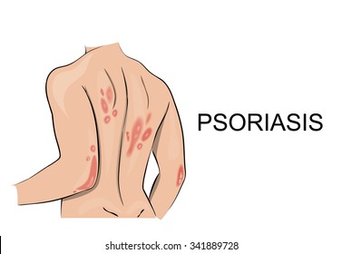 Psoriatic Rash. Dermatology. Allergic Reaction, Redness, Itching, Peeling Skin