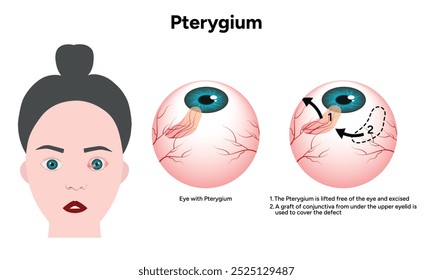 Doença ocular do pterígio e consulta de optometria ocular saudável 