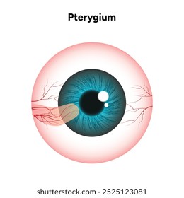Pterygia-Augenerkrankung