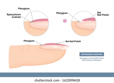 Pterygium and Gel Nail Polish. Nail Extension Mistakes. Professional Manicure Tutorial. Vector illustration