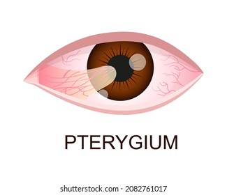 Pterygium growing onto the cornea. Conjunctival degeneration. Eye disease. Human organ of vision with pathology. Vector realistic illustration.