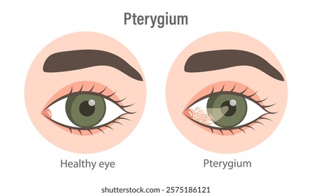 Pterygium. Healthy eye and affected eye. Medical infographic banner
