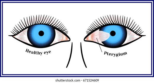 Pterygium. Spreading of the conjunctiva of the eye on the cornea.