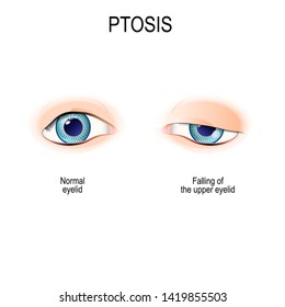 upper eyelid ptosis
