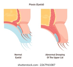 Ptosis. Caída del párpado superior. Ojo perezoso causado por músculos debilitados o daño de los nervios. Diagnóstico y tratamiento de oftalmólogos. Ilustración vectorial plana