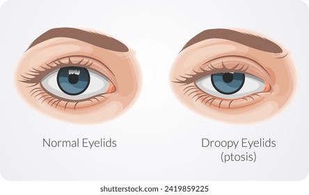 Ptosis drooping upper eyelid - Stock Illustration as EPS 10 File