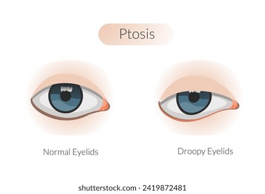 Ptosis ahogando párpado superior - Ilustración estándar como archivo EPS 10