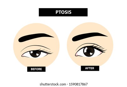 Ptosis Of Eyelid Before And After Vector Illustration