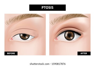 Ptosis of eyelid before and after vector illustration