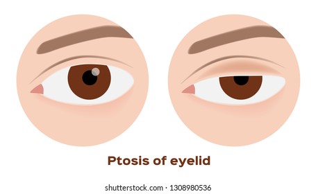 ptosis of eyelid . eye sickness anatomy