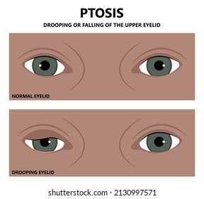 Ptosis eyelid lag Horner syndrome third nerve palsy retraction droopy	