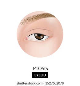 Ptosis Of Eyelid Vector Illustration